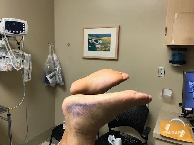 Achilles Rupture Matles Sign 1 Image of Achilles Rupture Matles Sign 1