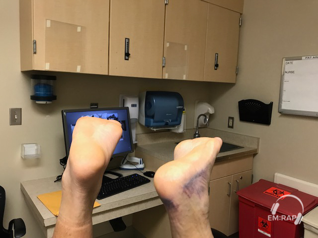 Achilles Rupture Matles Sign 2 Image of Achilles Rupture Matles Sign 2