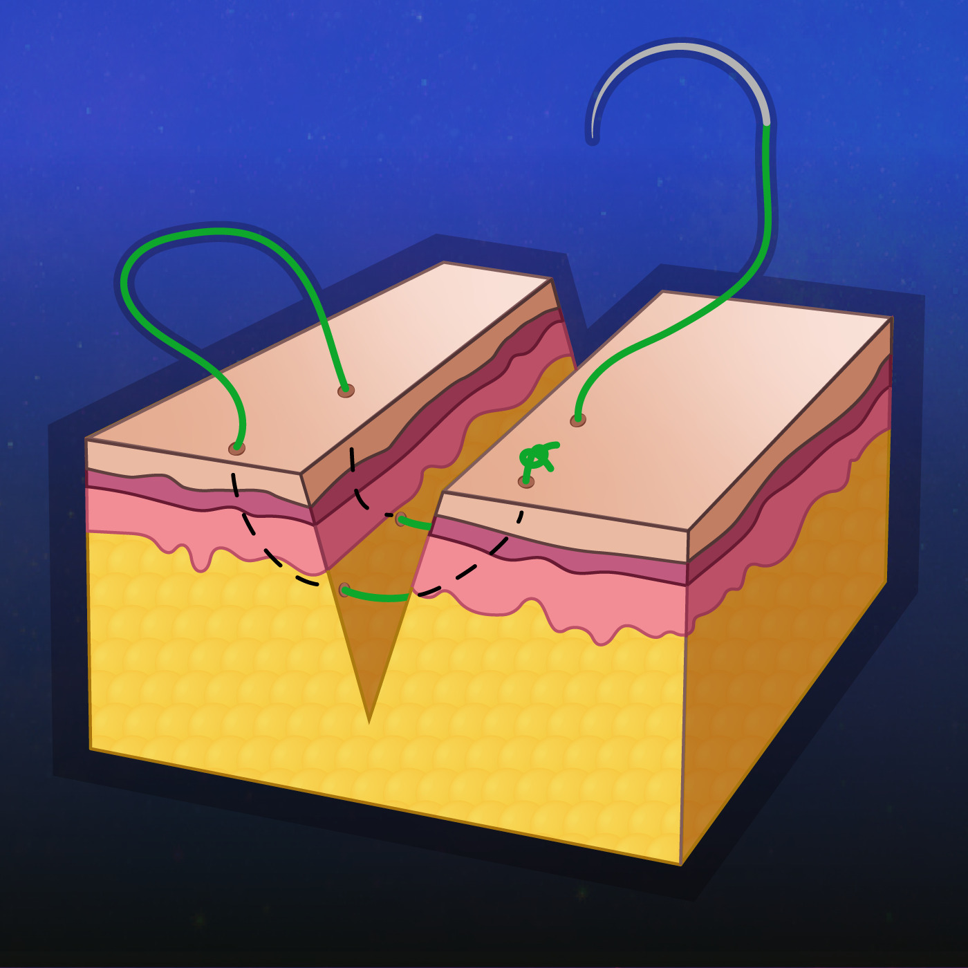 UC Max Laceration Lessons Suturing Tips and Tricks for Simple