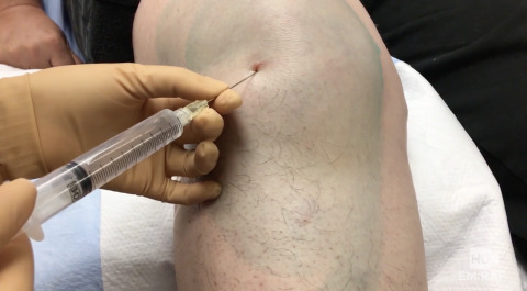 Knee Arthrocentesis and Intraarticular Injection Artwork