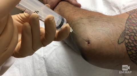 Elbow Arthrocentesis Artwork