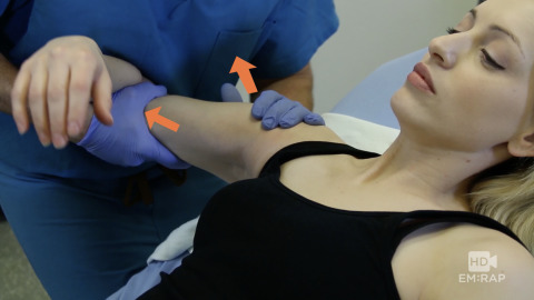 Reduction of Posterior Shoulder Dislocation Artwork