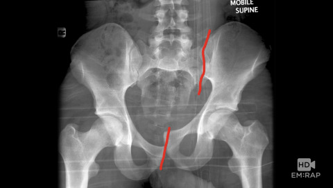 Pelvic Fractures Artwork