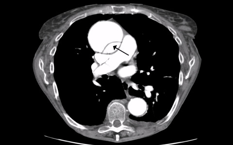 Ultrasound of Aortic Dissection Artwork
