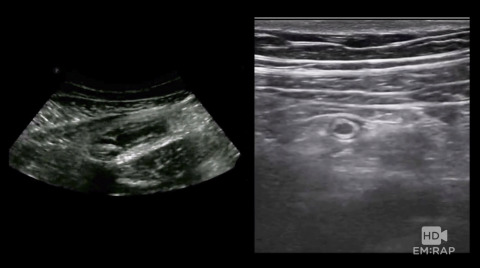 Ultrasound of Appendicitis Artwork