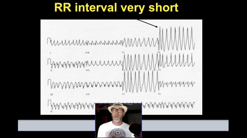 Tachyarrhythmias Lecture Artwork