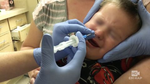 Nasal Foreign Body Extraction Using Balloon Catheter Artwork