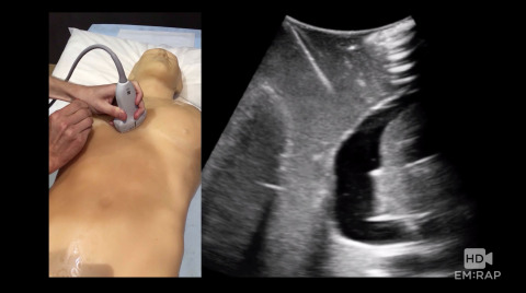 Ultrasound of ROSC Artwork