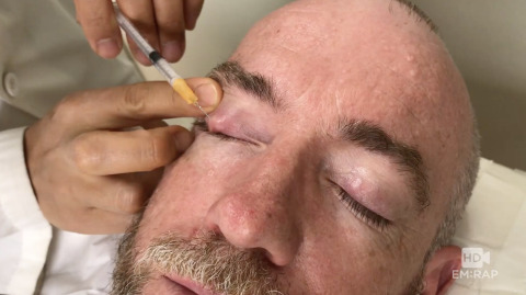 Chalazion Injection Artwork