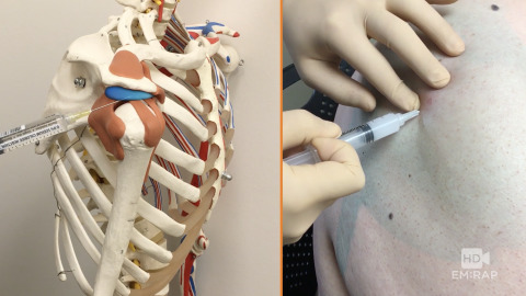 Subacromial Bursa Injection for Impingement Syndrome Artwork