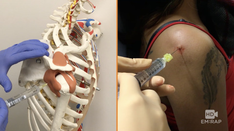 Shoulder Joint Injection Artwork