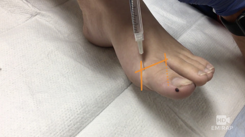 Removal of Ingrown Toenail Artwork