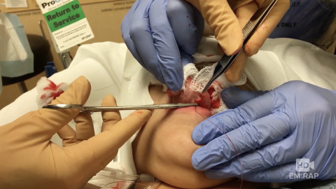 Tongue Laceration Repair with Sutures Artwork