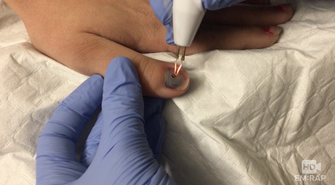 Trephination of a Fingernail Subungual Hematoma Artwork