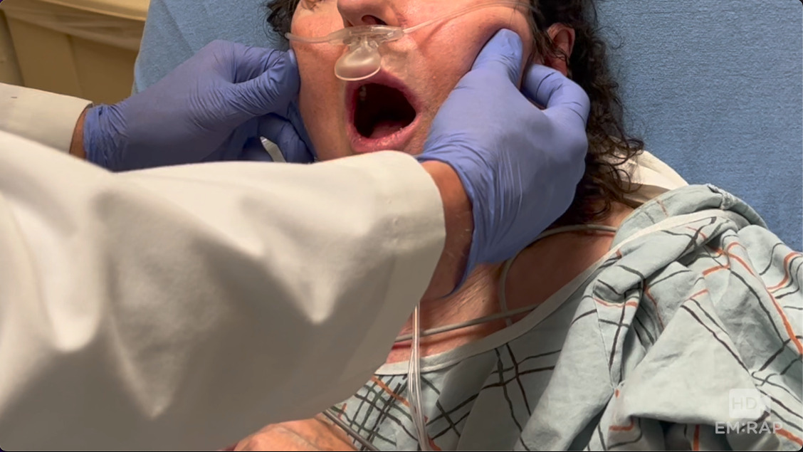 HD Jaw Reduction by Extraoral Technique Presented by Al Sacchetti